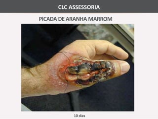 CLC ASSESSORIA 
PICADA DE ARANHA MARROM 
10 dias 
 