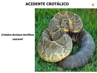Crotalus durissus terrificus
cascavel
ACIDENTE CROTÁLICO
 