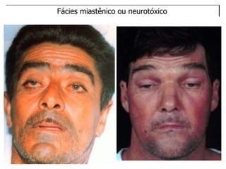 Fácies miastênico ou neurotóxico
 