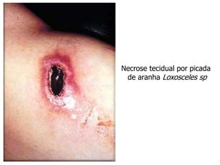 Necrose tecidual por picada
de aranha Loxosceles sp
 