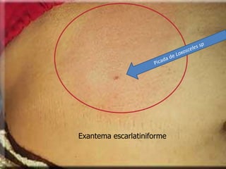 Exantema escarlatiniforme
 