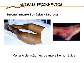 ANIMAIS PEÇONHENTOS
Envenenamento Botrópico – Jararacas

Veneno de ação necrosante e hemorrágica

 
