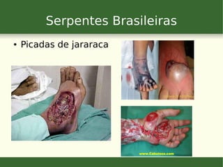 Serpentes Brasileiras
● Picadas de jararaca
 
