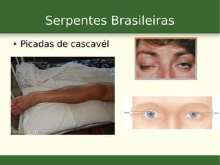 Serpentes Brasileiras
● Picadas de cascavél
 