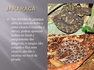  Nas picadas de jararaca,
além da cara-de-bobo e
urina escura (vermelha e
turva), podem aparecer
bolhas no local e
sangramento das
gengivas; o sangue não
coagula e fica uma
cicatriz, devido à
necrose no local da
picada.
 