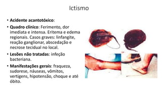 Ictismo
• Acidente acantotóxico:
• Quadro clínico: Ferimento, dor
imediata e intensa. Eritema e edema
regionais. Casos graves: linfangite,
reação ganglionar, abscedação e
necrose tecidual no local.
• Lesões não tratadas: infeção
bacteriana.
• Manifestações gerais: fraqueza,
sudorese, náuseas, vômitos,
vertigens, hipotensão, choque e até
óbito.
 