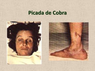 Picada de Cobra
 