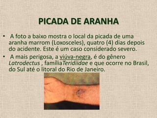 PICADA DE ARANHA
• A foto a baixo mostra o local da picada de uma
aranha marrom (Loxosceles), quatro (4) dias depois
do acidente. Este é um caso considerado severo.
• A mais perigosa, a viúva-negra, é do gênero
Latrodectus , famíliaTeridiidae e que ocorre no Brasil,
do Sul até o litoral do Rio de Janeiro.
 