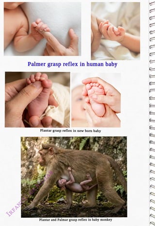 Palmer grasp reflex in human baby
<br>
Plantar grasp reflex in new born baby
<br>
Plantar and Palmar grasp reflex in baby monkey
<br>
 