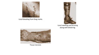 Local bleeding from fang marks
Local swelling and bruising
along with blistering
Tissue necrosis
 