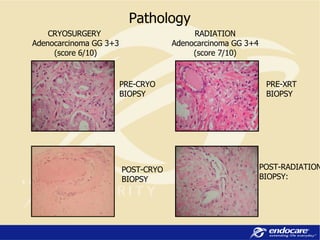 Pathology CRYOSURGERY  Adenocarcinoma GG 3+3 (score 6/10) POST-CRYO BIOPSY POST-RADIATION BIOPSY: RADIATION Adenocarcinoma GG 3+4 (score 7/10) PRE-CRYO BIOPSY PRE-XRT BIOPSY 
