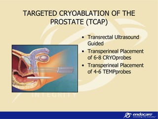 Transrectal Ultrasound Guided Transperineal Placement of 6-8 CRYOprobes Transperineal Placement of 4-6 TEMPprobes TARGETED CRYOABLATION OF THE PROSTATE (TCAP) 