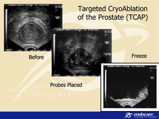 Targeted CryoAblation of the Prostate (TCAP) Before  Probes Placed  Freeze 
