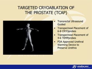 Transrectal Ultrasound Guided Transperineal Placement of 6-8 CRYOprobes Transperineal Placement of 4-6 TEMPprobes FDA Approved Urethral Warming Device to Preserve Urethra TARGETED CRYOABLATION OF THE PROSTATE (TCAP) 