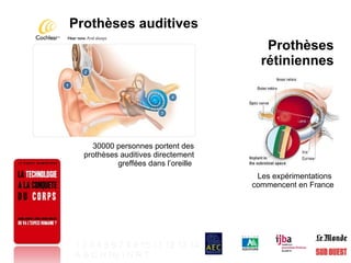 30000 personnes portent des prothèses auditives directement greffées dans l’oreille  Prothèses auditives Prothèses rétiniennes Les expérimentations  commencent en France 1   2   3   4   5   6   7   8   9   10   11   12   13   14 A   B   C   H   Hy   I   N   R   T   