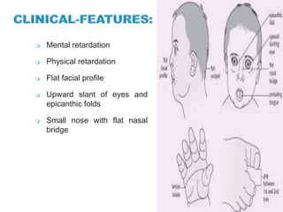  Mental retardation
 Physical retardation
 Flat facial profile
 Upward slant of eyes and
epicanthic folds
 Small nose with flat nasal
bridge
 