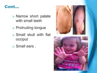  Narrow short palate
with small teeth
 Protruding tongue
 Small skull with flat
occiput
 Small ears .
 