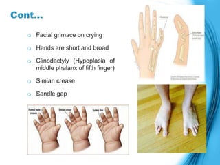  Facial grimace on crying
 Hands are short and broad
 Clinodactyly (Hypoplasia of
middle phalanx of fifth finger)
 Simian crease
 Sandle gap
 