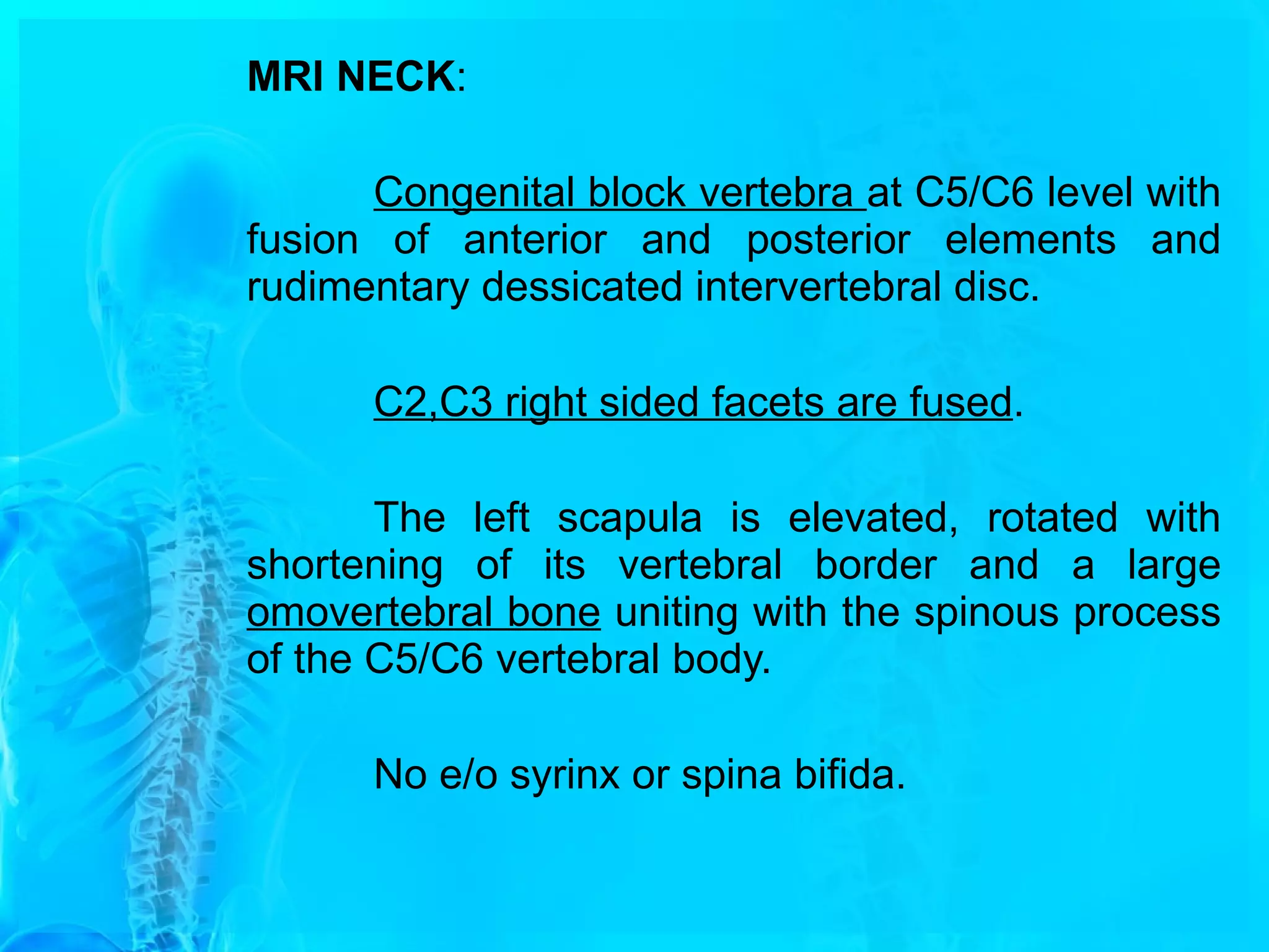 A Case of Klippel Feil anomaly with Sprengel Shoulder | PPT