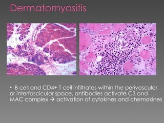 A Case of Dermatomyositis