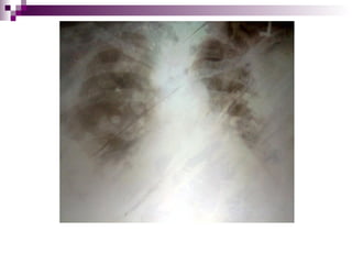 A case of SLE polyserositis & pneumonitis