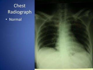 Chest
 Radiograph
• Normal
 