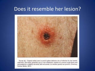 Does it resemble her lesion?
 