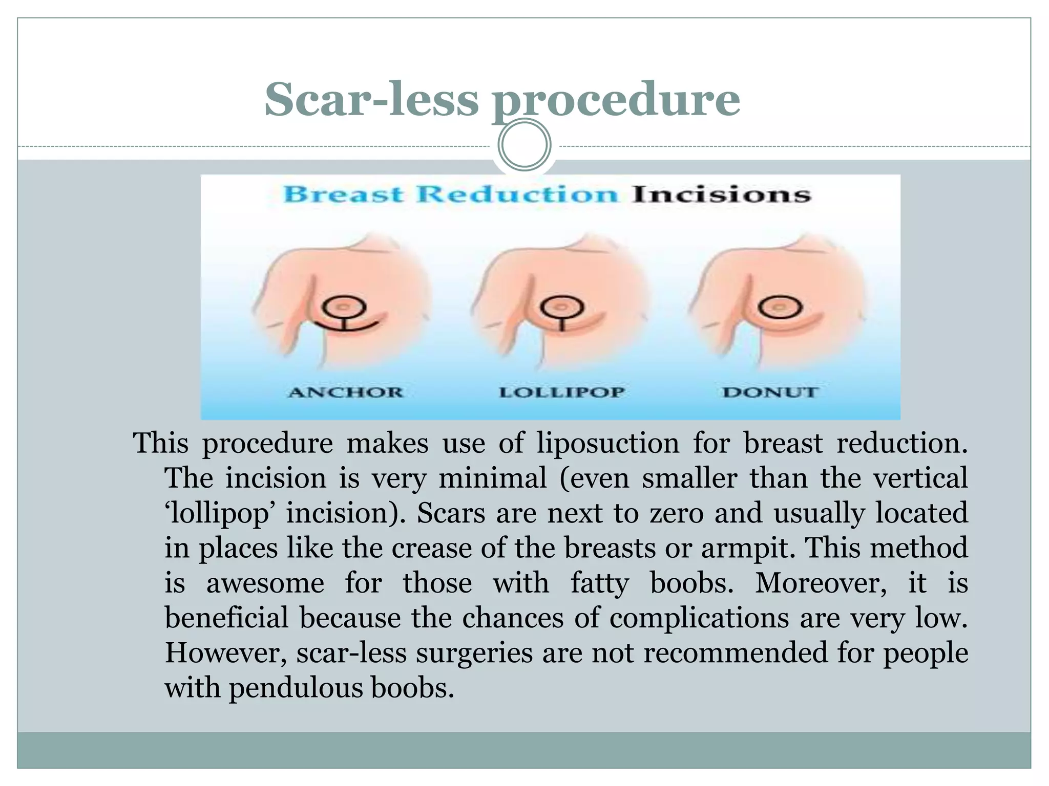 Axillary Incision Types Know Everything About Breast Reduction | PPTX