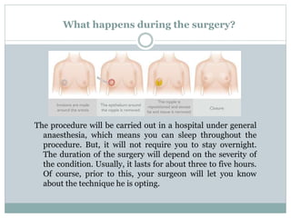 What happens during the surgery?
The procedure will be carried out in a hospital under general
anaesthesia, which means you can sleep throughout the
procedure. But, it will not require you to stay overnight.
The duration of the surgery will depend on the severity of
the condition. Usually, it lasts for about three to five hours.
Of course, prior to this, your surgeon will let you know
about the technique he is opting.
 
