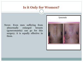 Is it Only for Women?
Never. Even men suffering from
abnormally enlarged breasts
(gynecomastia) can go for this
surgery; it is equally effective in
them.
 
