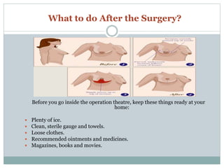 What to do After the Surgery?
Before you go inside the operation theatre, keep these things ready at your
home:
 Plenty of ice.
 Clean, sterile gauge and towels.
 Loose clothes.
 Recommended ointments and medicines.
 Magazines, books and movies.
 