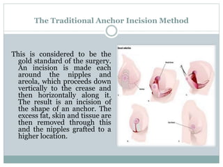 The Traditional Anchor Incision Method
This is considered to be the
gold standard of the surgery.
An incision is made each
around the nipples and
areola, which proceeds down
vertically to the crease and
then horizontally along it.
The result is an incision of
the shape of an anchor. The
excess fat, skin and tissue are
then removed through this
and the nipples grafted to a
higher location.
 
