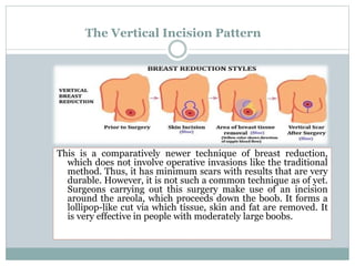 The Vertical Incision Pattern
This is a comparatively newer technique of breast reduction,
which does not involve operative invasions like the traditional
method. Thus, it has minimum scars with results that are very
durable. However, it is not such a common technique as of yet.
Surgeons carrying out this surgery make use of an incision
around the areola, which proceeds down the boob. It forms a
lollipop-like cut via which tissue, skin and fat are removed. It
is very effective in people with moderately large boobs.
 