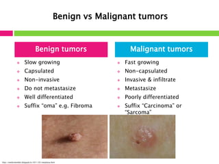 Benign vs Malignant tumors 
Benign tumors Malignant tumors 
 Slow growing 
 Capsulated 
 Non-invasive 
 Do not metastasize 
 Well differentiated 
 Suffix “oma” e.g. Fibroma 
 Fast growing 
 Non-capsulated 
 Invasive & infiltrate 
 Metastasize 
 Poorly differentiated 
 Suffix “Carcinoma” or 
“Sarcoma” 
http://medicinembbs.blogspot.kr/2011/02/neoplasia.html 
 