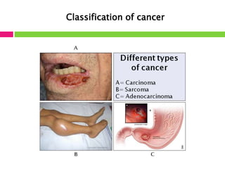 Classification of cancer 
 