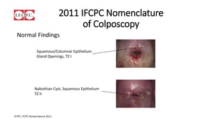 2011 IFCPC Nomenclature
of Colposcopy
Normal Findings
Squamous/Columnar Epithelium
Gland Openings, TZ I
Nabothian Cyst, Squamous Epithelium
TZ II
 