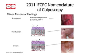 2011 IFCPC Nomenclature
of Colposcopy
Minor Abnormal Findings
Acetowhite Epethilum
3 o’ clock, HPV +
Punctuation
Mosaic
Acetowhite
 