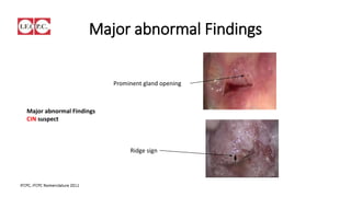 Minor abnormal Findings
Abnormal Findings (Normal vascular Pattern)
Normally vessel patterns of the cervical epithelium
over a Nabothian Cyst
 