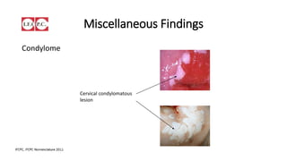 Findings suspicious for Invasion
Atypical vascular Patterns
C
A
N
C
E
R
 