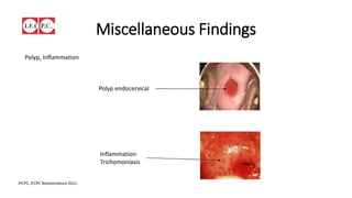 2011 IFCPC Nomenclature
of Colposcopy
Miscellaneous finding
 