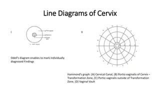 Miscellaneous Findings
Polyp endocervical
Inflammation
Trichomoniasis
Polyp, Inflammation
IFCPC, IFCPC Nomenclature 2011
 