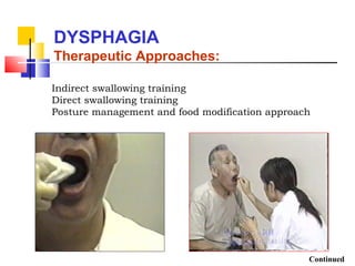Indirect swallowing training
Direct swallowing training
Posture management and food modification approach
DYSPHAGIA
Therapeutic Approaches:
Continued
 