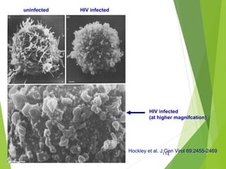 114
Hockley et al. J Gen Virol 69:2455-2469
uninfected HIV infected
HIV infected
(at higher magnifcation)
 