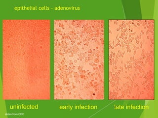 epithelial cells - adenovirus
119uninfected early infection late infection
slides from CDC
 