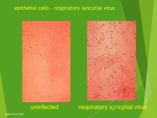 epithelial cells - respiratory syncytial virus
120uninfected respiratory syncytial virus
slides from CDC
 