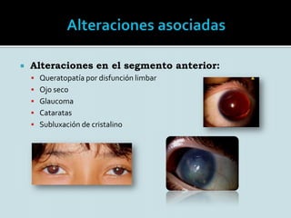 Ocurre como una alteración fenotípicamente heterogéneaPodemos encontrar 2 tipos de aniridia según su origen:- Aniridia tipo I : Es la forma hereditaria. Autosómica dominante- Aniridia tipo II : Es la forma esporádica de la aniridia.