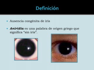 DefiniciónAusencia congénita de irisAniridia es una palabra de origen griego que significa “sin iris”.