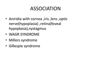 Aniridia | PPTX