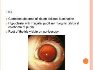 Aniridia and low vision | PPTX
