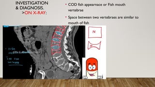 Osteoporosis).pptxdgfsrgvdfgghukjuyfdwfhuijg | PPTX
